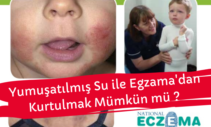 YUMUŞATILMIŞ SU İLE EGZAMA'DAN KURTULMAK MÜMKÜN MÜ ?